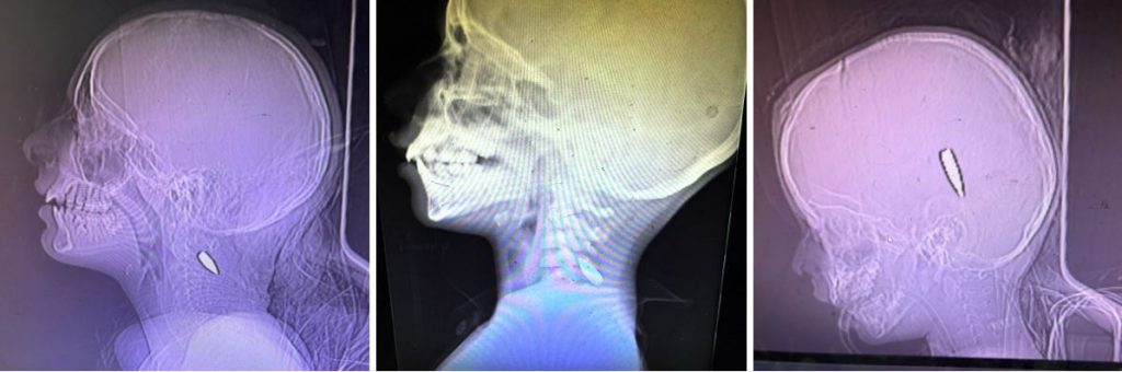 skull-xrays_shrapnel